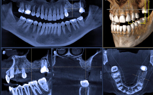 tomografem-3D-CBCT-koszalin