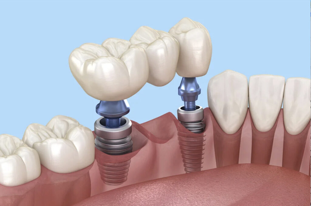 most na implantach koszalin